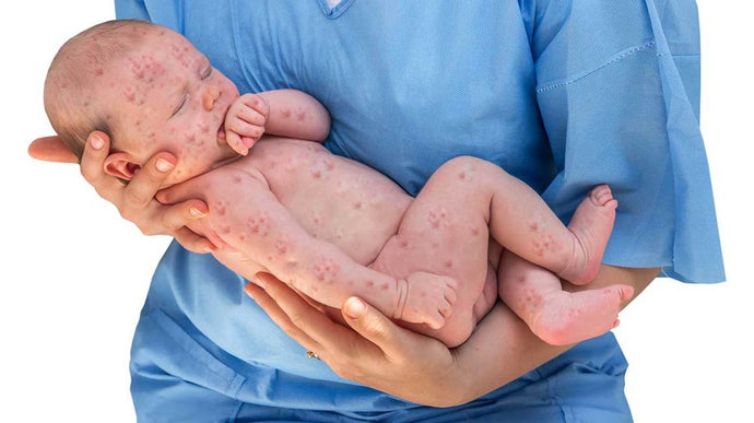 Herpes in babies