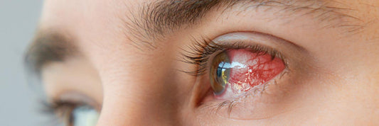 Herpes simplex eye infections