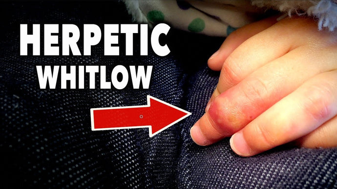 Herpetic whitlow (whitlow finger)