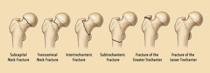 Hip fracture