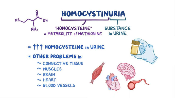 Homocystinuria