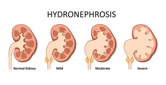 Hydronephrosis