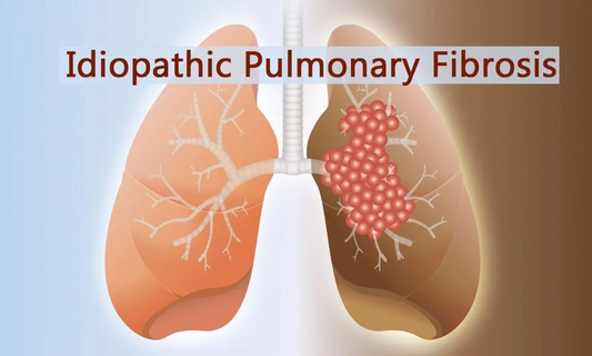 Idiopathic pulmonary fibrosis