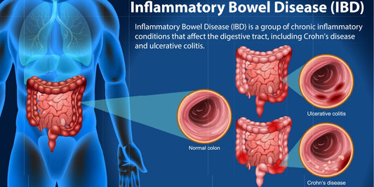 Inflammatory bowel disease