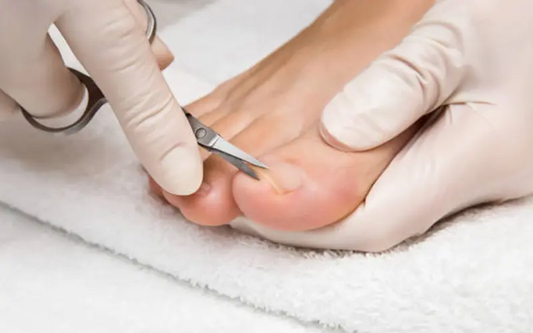 Ingrown toenail