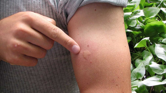 Insect bites and stings