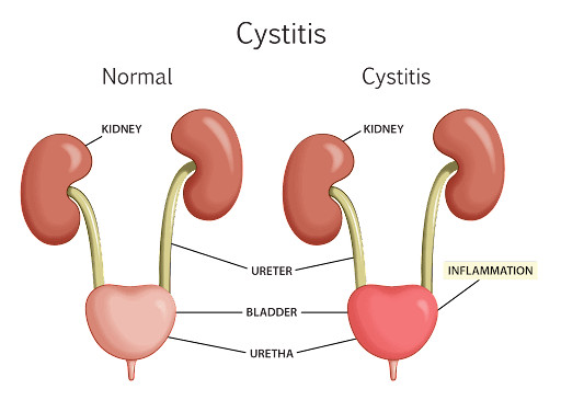 Interstitial cystitis