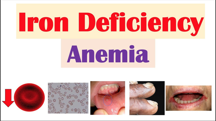 Iron deficiency anaemia