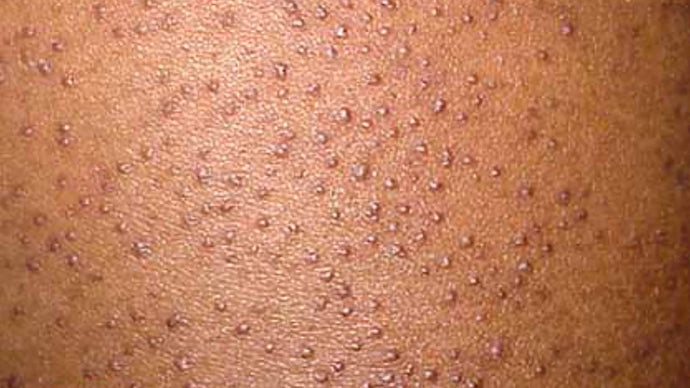 Keratosis pilaris