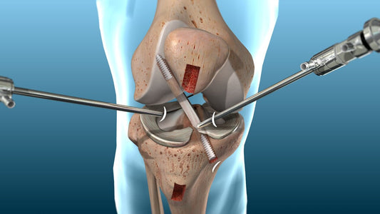 Knee ligament surgery