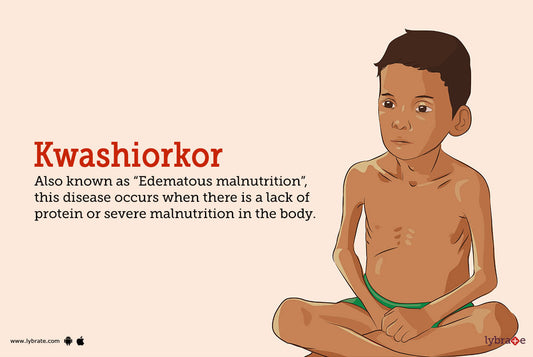 Kwashiorkor