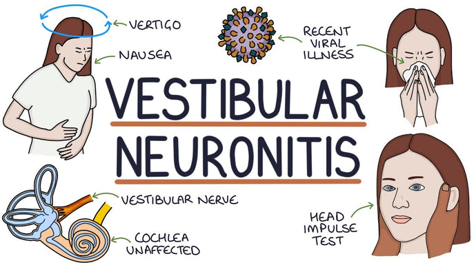 Labyrinthitis and vestibular neuritis