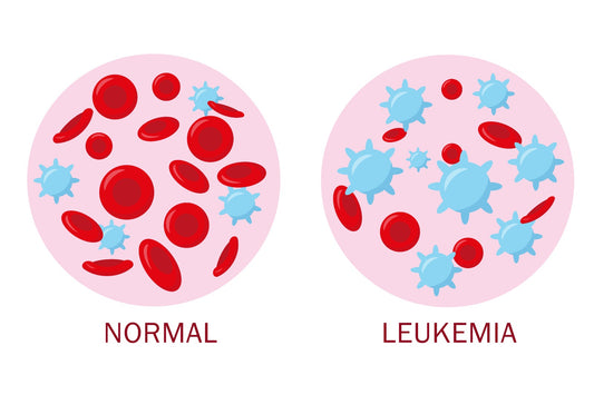 Leukaemia (chronic myeloid)