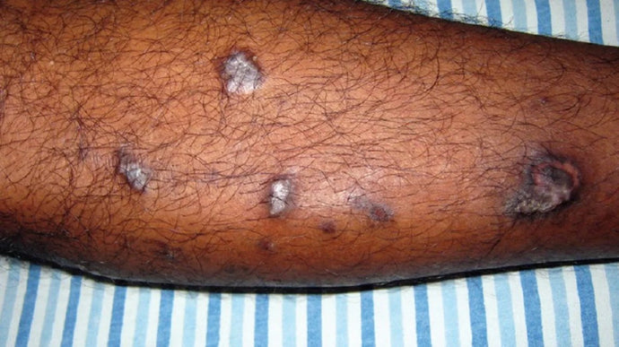 Lichen planus