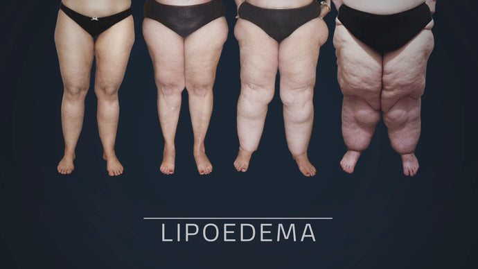 Lipoedema