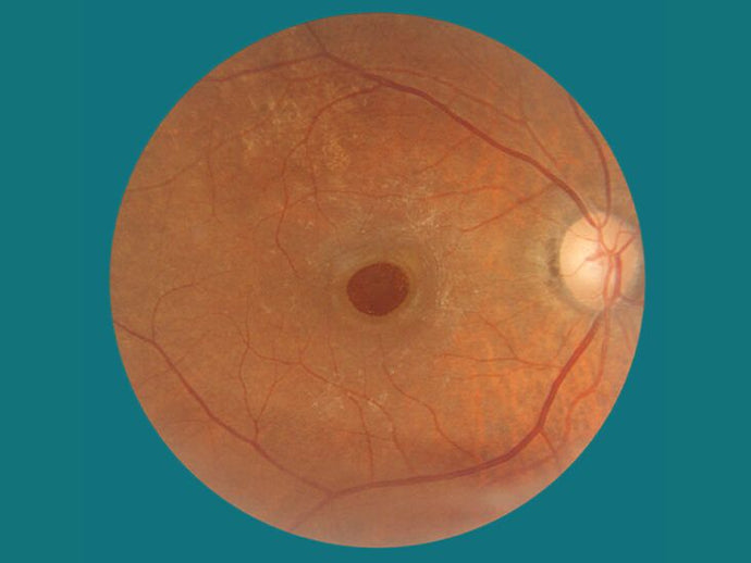 Macular hole