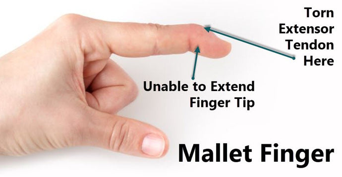 Mallet finger