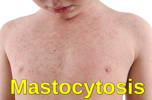 Mastocytosis