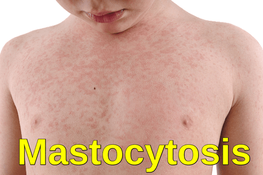 Mastocytosis