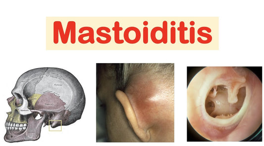 Mastoiditis