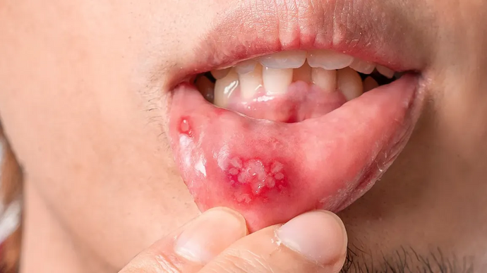 Mouth ulcers