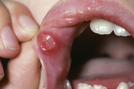 Mucositis