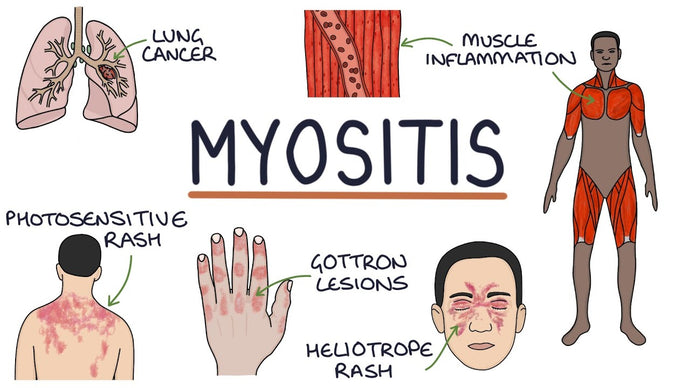 Myositis (polymyositis and dermatomyositis)