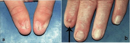 Nail patella syndrome