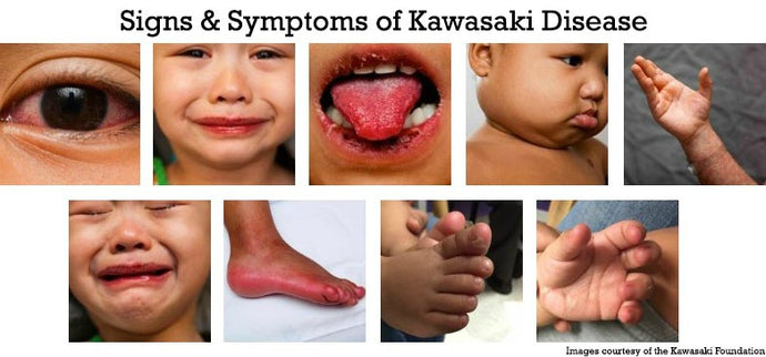 Kawasaki disease