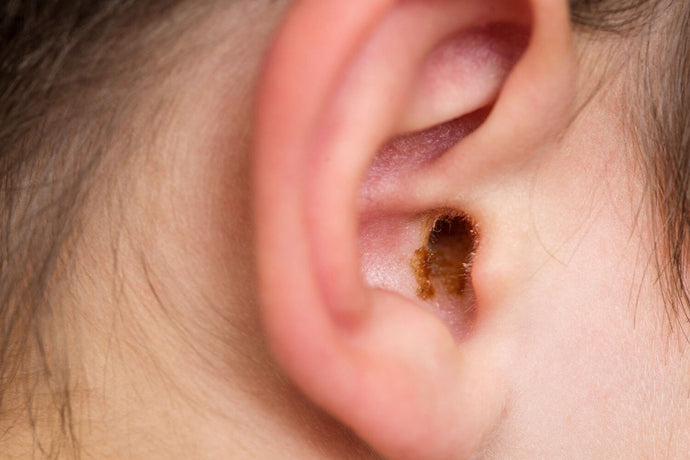 Glue ear