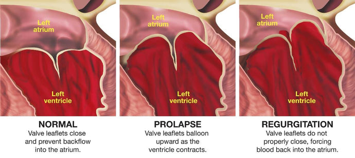 Mitral valve problems