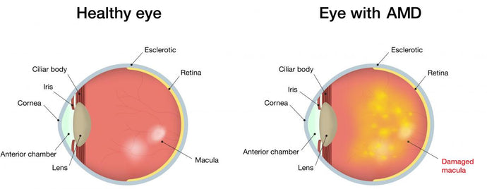 Macular degeneration (age-related)