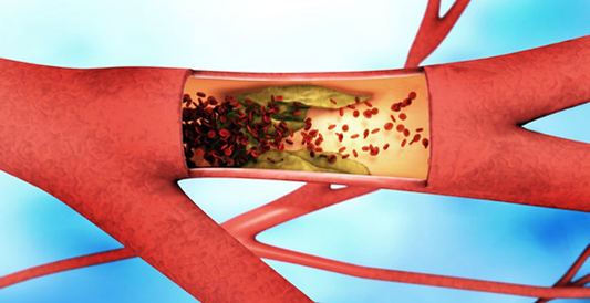 Arterial thrombosis