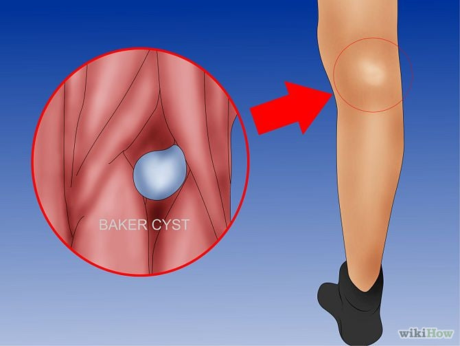 Baker's cyst