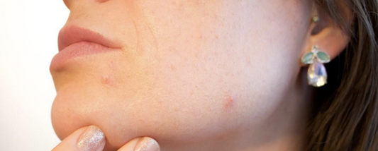 Basal cell carcinoma