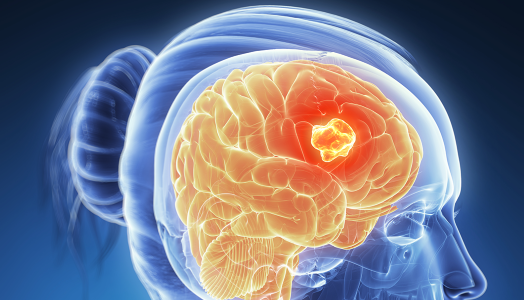 Malignant brain tumour (brain cancer)