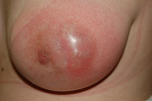 Breast abscess