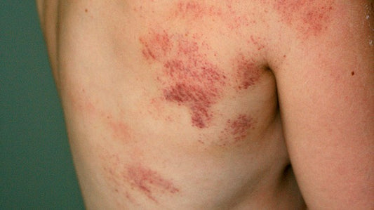 Broken or bruised ribs