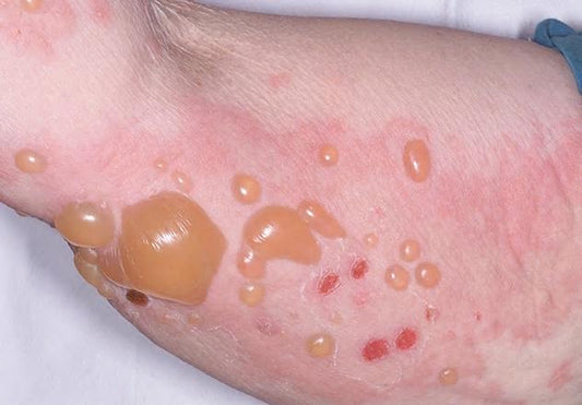 Bullous pemphigoid