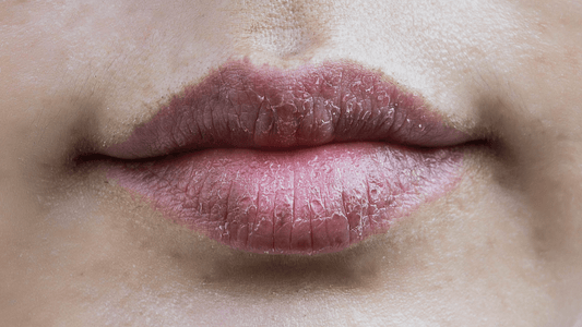 Dry lips