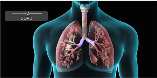 Chronic obstructive pulmonary disease (COPD)