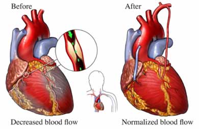 CABG