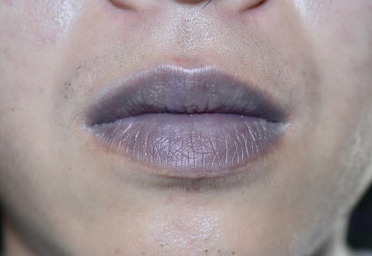 Blue skin or lips (cyanosis)