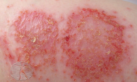 Discoid eczema