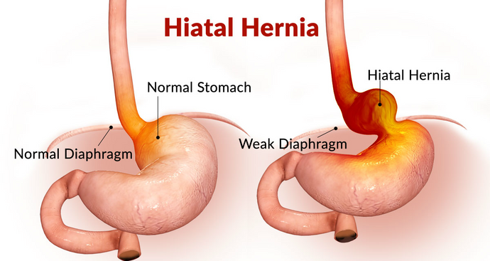 Hernia (hiatus)