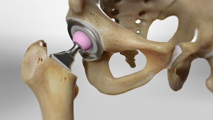 Hip replacement