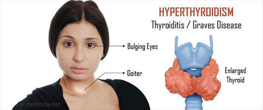 Hyperthyroidism