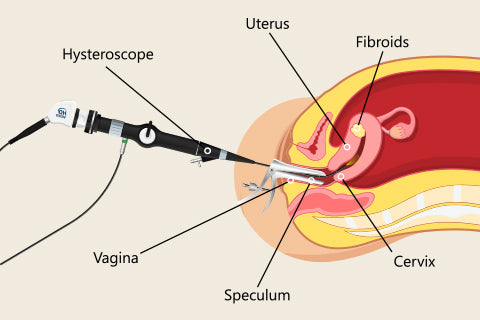 Hysteroscopy