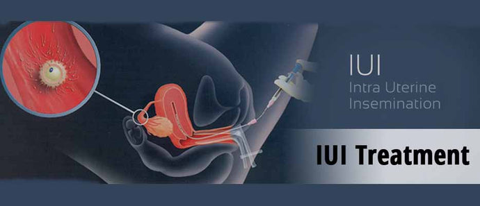 Intrauterine insemination (IUI)