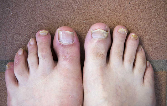 Nail fungal infection